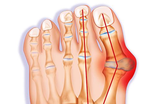 Příznaky deformity palce nohy a způsoby léčby.