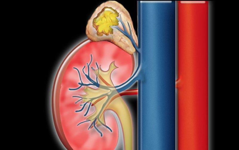 Cushingův syndrom: Příčiny, příznaky a léčba