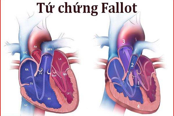 Fallotova tetralogie: Nejběžnější cyanotická vrozená srdeční choroba