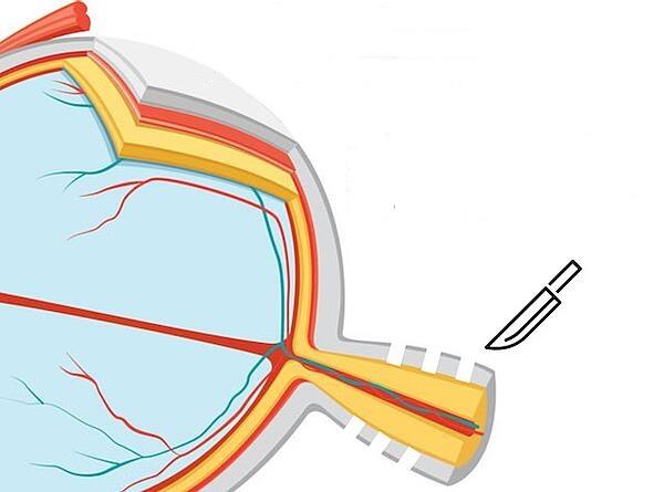 Pseudotumorové onemocnění mozku: Příčiny, diagnostika a léčba