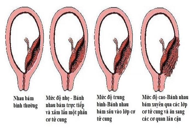 Těhotenství po císařském řezu: Důležité poznámky