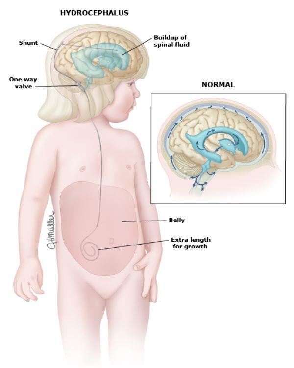 Konvenční medicína: Hydrocefalus