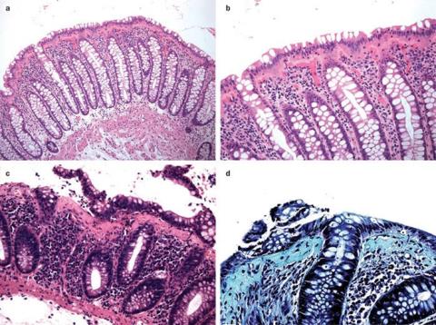 Mikroskopická kolitida: Příčiny, diagnostika a léčba