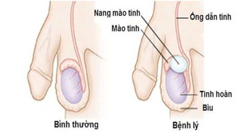 Epididymální cysta je nebezpečné onemocnění u mužů?