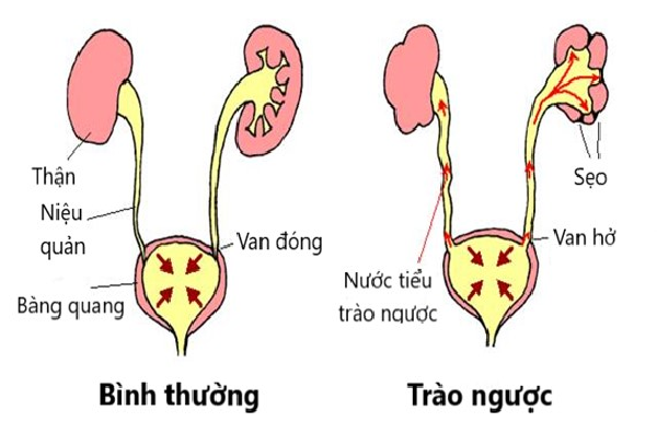 Vezikoureterální reflux: Příčiny, rizika a komplikace