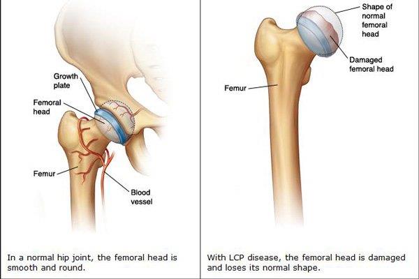 Primární osteoartróza kyčle: Příčiny, diagnostika a léčba