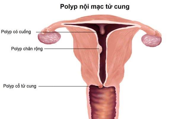 Děložní polypy: Co potřebujete vědět!