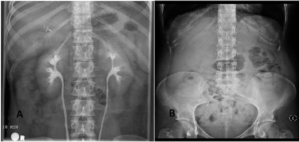 Co je to ureterální obstrukce a jak vás trápí?