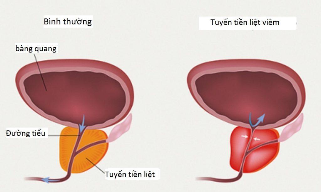 Cysta prostaty: Patologie nemůže být subjektivní