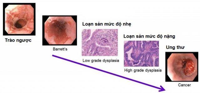 Barrettův jícen: Diagnostika a léčba