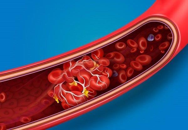 Primární polycythemia vera: Projevy, diagnostika a léčba