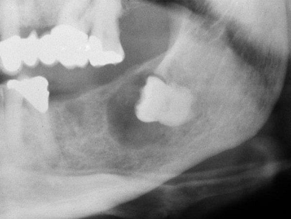 Korunní cysty: příčiny, diagnostika a léčba