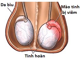 Může orchitida způsobit neplodnost?