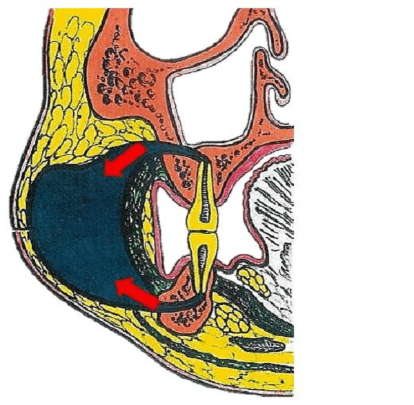 Lícní absces: Příčiny, příznaky a léčba.