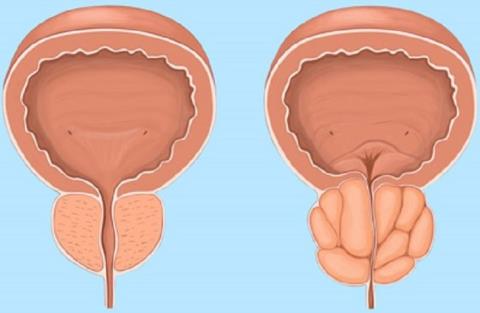 Onemocnění prostaty a související informace