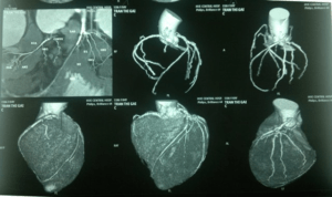 Koronární angiografie: Je to nebezpečné?