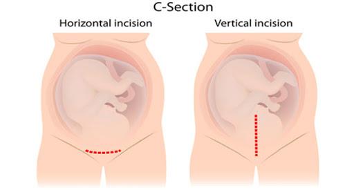 Těhotenství po císařském řezu: Důležité poznámky