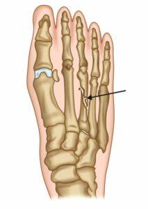 Zlomenina chodidla: Základní znalosti, které je třeba znát