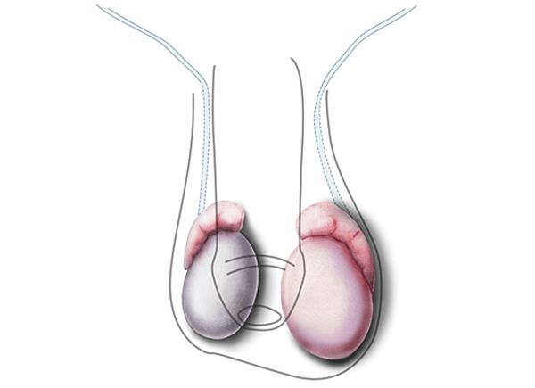 Onemocnění varlat, před kterými by se muži měli mít na pozoru