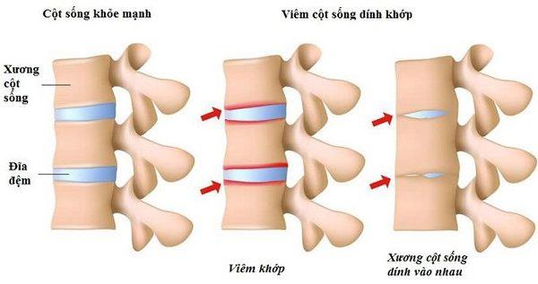 Ankylozující spondylitida: Příčiny, příznaky a pokyny pro léčbu