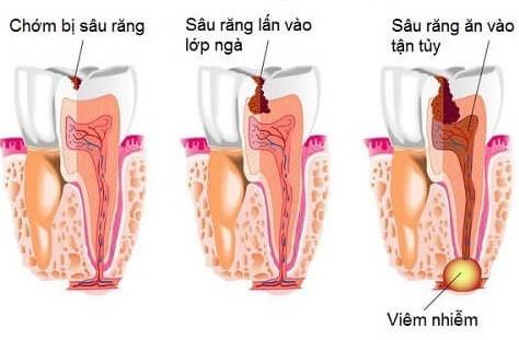 Zánět zubní dřeně: Příčiny, diagnostika a léčba