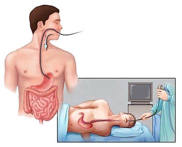 Barrettův jícen: Diagnostika a léčba