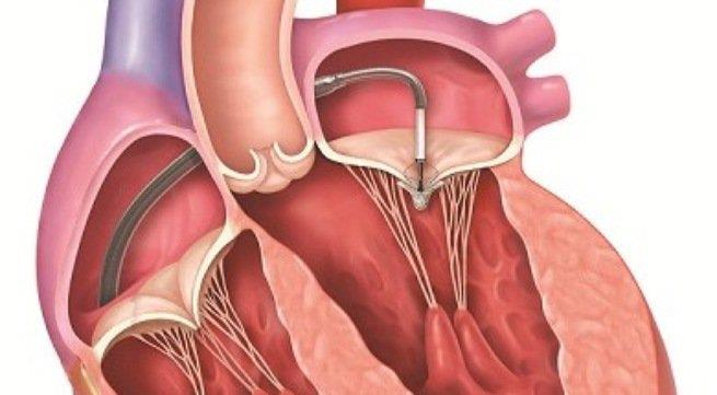 Stenóza mitrální chlopně: Příčiny, příznaky, léčba