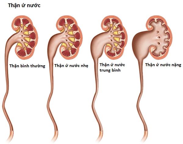 Co je to ureterální obstrukce a jak vás trápí?