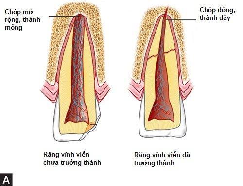 Léčba kořenových kanálků u dětí ve vývoji stálých zubů