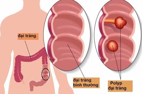 Polypy tlustého střeva: Jak často je třeba opakovat kolonoskopii?