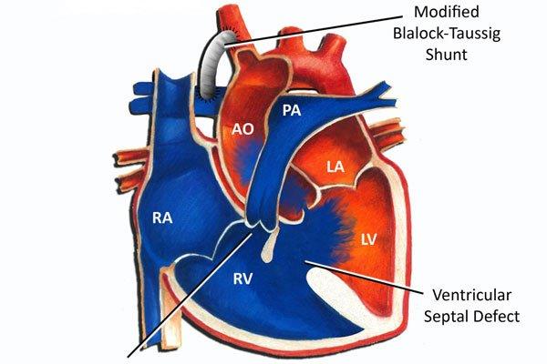 Fallotova tetralogie: Nejběžnější cyanotická vrozená srdeční choroba