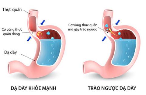 Gastroezofageální refluxní choroba: Co byste měli vědět