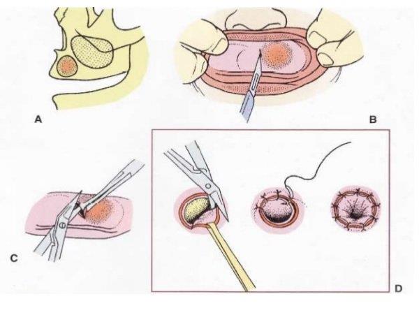 Korunní cysty: příčiny, diagnostika a léčba