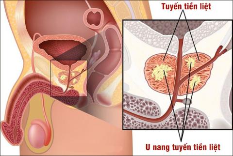 Cysta prostaty: Patologie nemůže být subjektivní