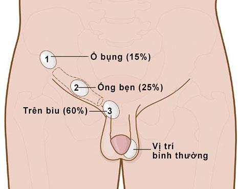 Onemocnění varlat, před kterými by se muži měli mít na pozoru