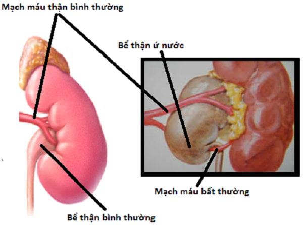 Co je to ureterální obstrukce a jak vás trápí?