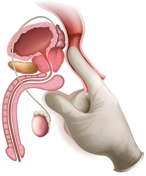 Co potřebujete vědět o zvětšení prostaty