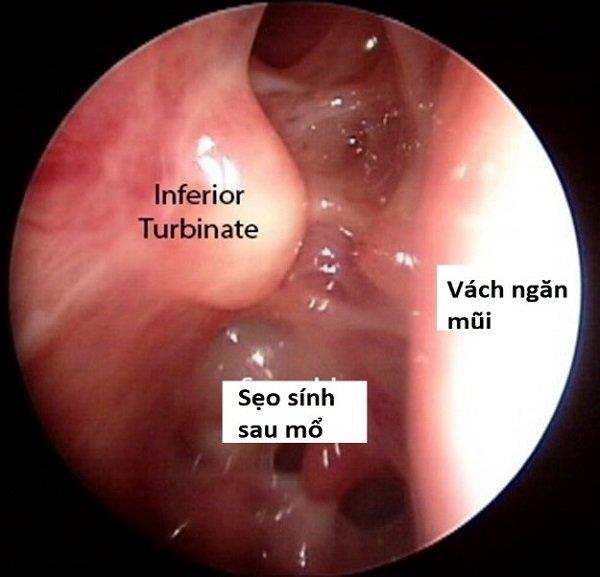 Plastika nosu: Vše, co potřebujete vědět