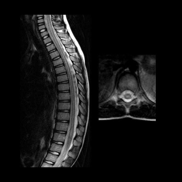 Příčná myelitida: příznaky, diagnostika a léčba?